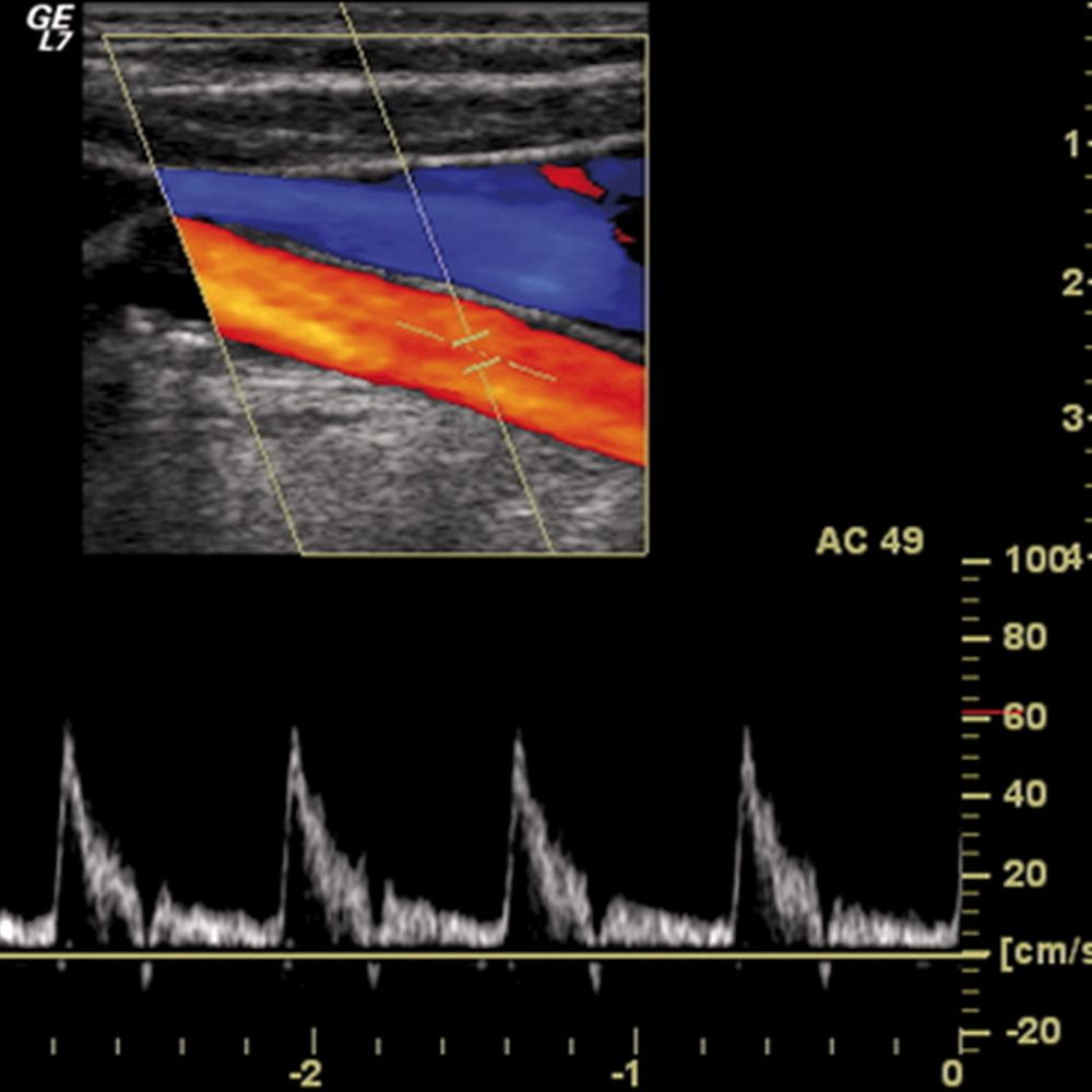 Schermata di ecocolordoppler con il flusso di un vaso sanguigno in rosso e blu e il tracciato della velocità